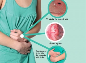 Bệnh viêm loét dạ dày có chữa khỏi được không?